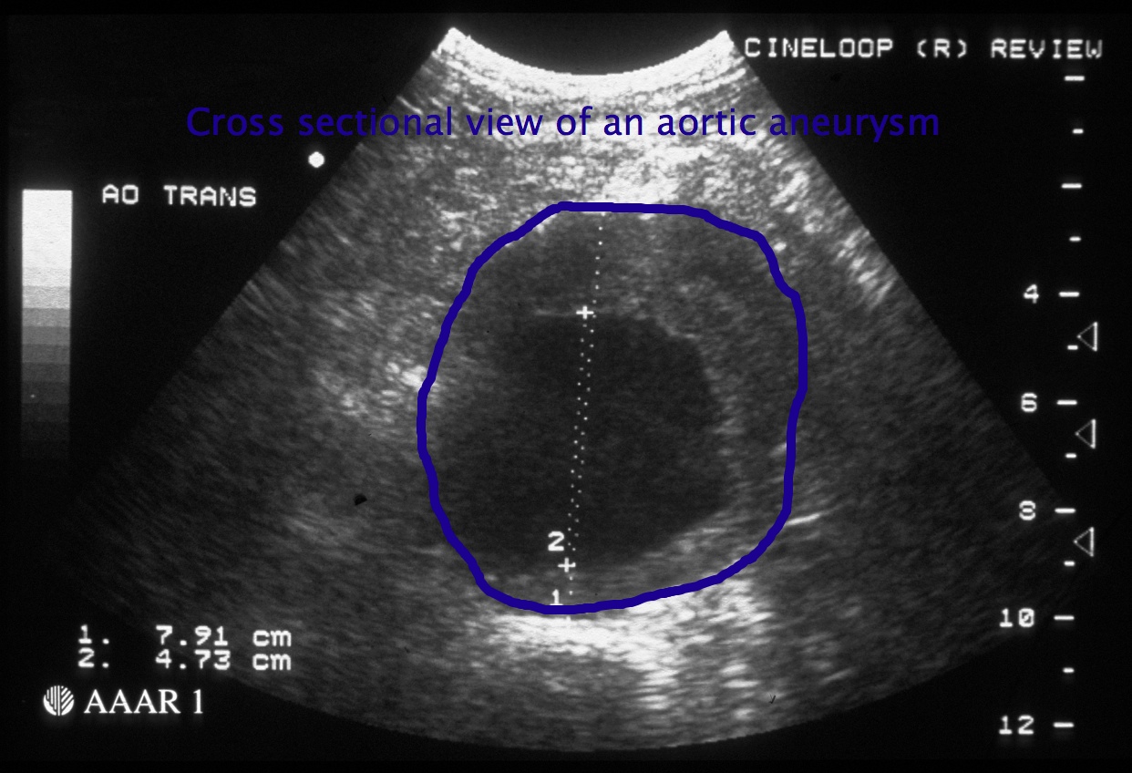 Aneurysm ultrasound