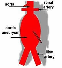 A diagram of an aortic aneurysm