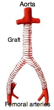 Aorto-bifemoral graft