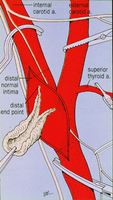 Carotid endarterectomy