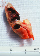 Specimen removed from carotid artery