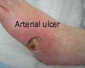 Arterial ulcer