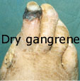 Dry gangrene of the second toe