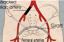 A femoro-femoral crossover graft